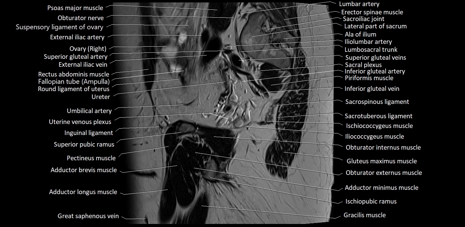 Sagittal cross sectional anatomy of female pelvis (MRI 3T) image 10.webp